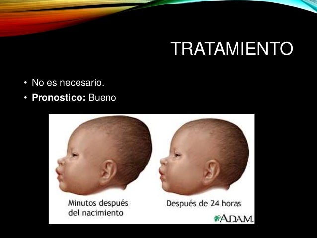 cefalohematoma tratamiento